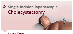 Single Incision Laparoscopic Cholecystectomy