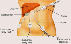 Cholecystectomy