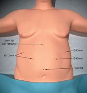 Single Incision Surgery