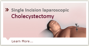 Cholecystectomy